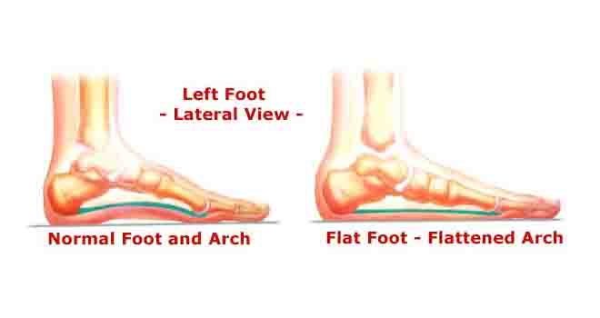 Flat Foot