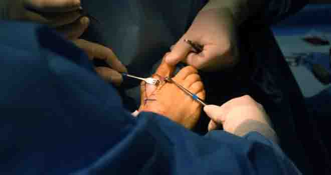 Neuroma Treatment