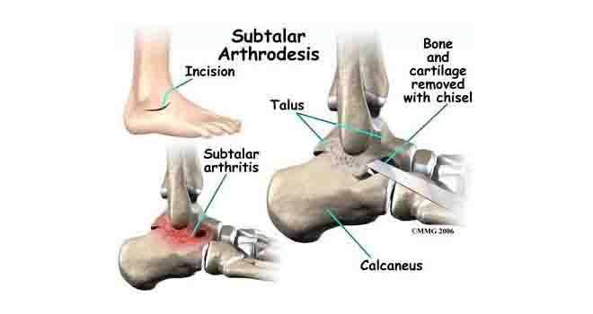Subtalar Arthritis