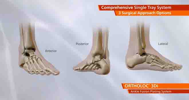 Ankle Fusion
