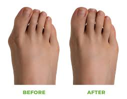 Ingrown Nail Before After