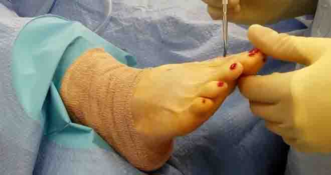 Big Toe Fusion