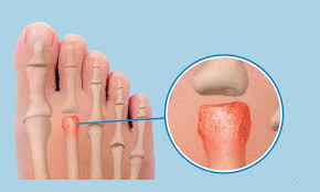 Freiberg's Disease