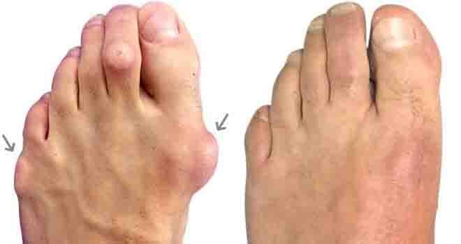 Toe Deformity Surgery